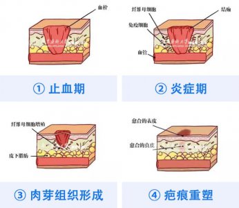 ​避免增生疤痕发物有哪些食物（疤痕增生凸起来一块肉怎么办）